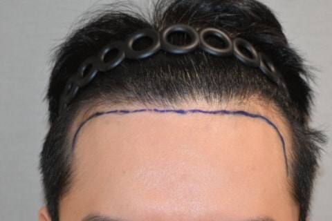 [모다올의원] 모다올 홍준현 원장님 비절개 2000모 +@ 1일차 후기(샴푸후 사진포함)