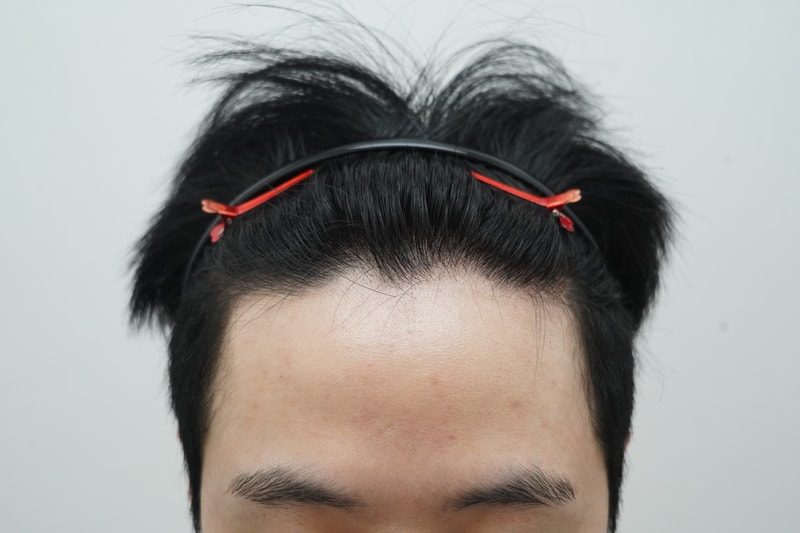 [연세모나의원]모발이식 1101모낭 심고 3주차 후기(feat 암흑기)