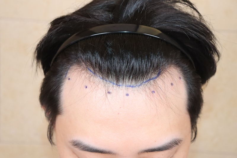 움찬의원 2800모 절개 모발이식 후기