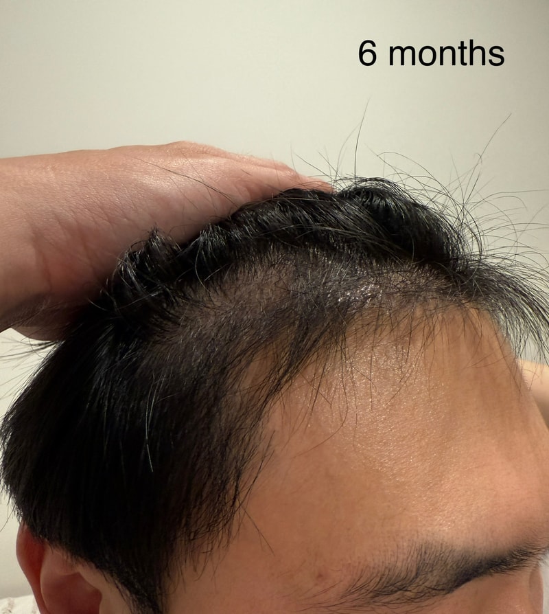 모발이식 6개월 차 후기