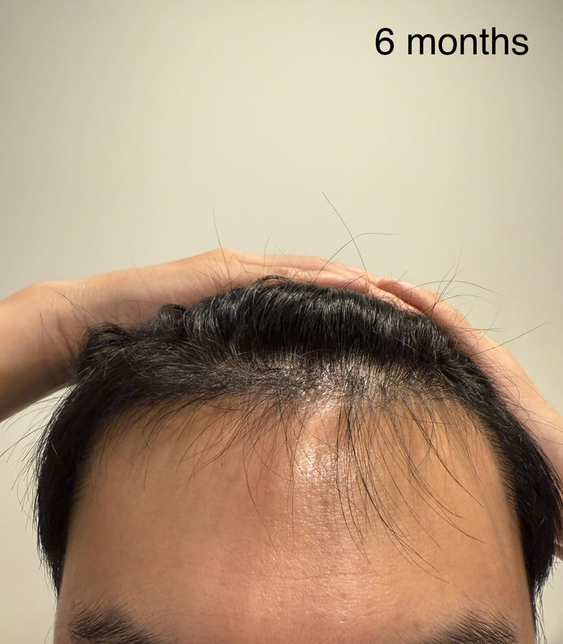 모발이식 6개월 차 후기