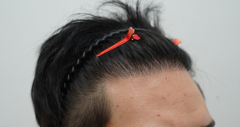 [연세모나의원]밀도 보강 20대 남자 후기입니다 사진 있음