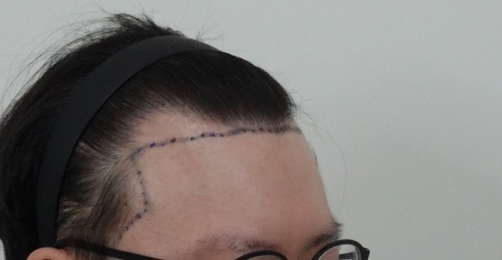 20대 비절개 모발이식 3200모 6개월차 리뷰남겨봐요