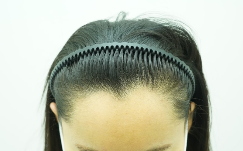 [ヨンセモナ医院] ヘアライン矯正体験談