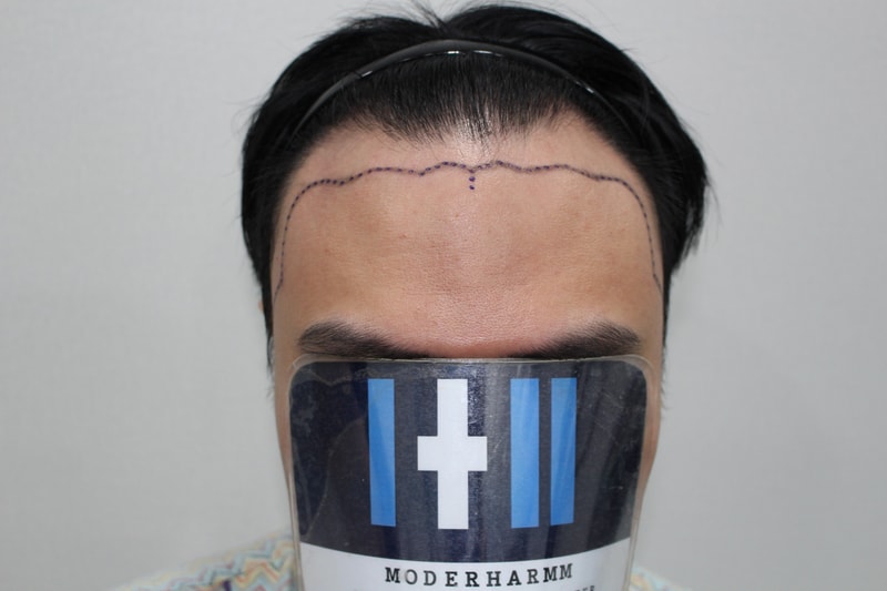 모더함 정한별 원장님 남성 모발이식 후기