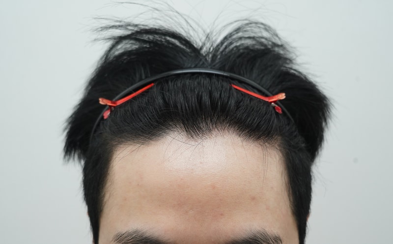 [연세모나의원]모발이식 1101모낭 심고 3주차 후기(feat 암흑기)