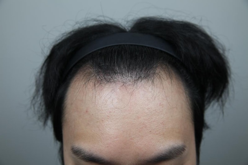 M자 이마 총 4430모 이식했습니다.