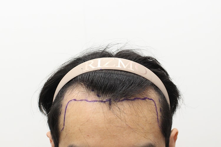 대전 리즈모에서 비절개로 이식하고 왔습니다