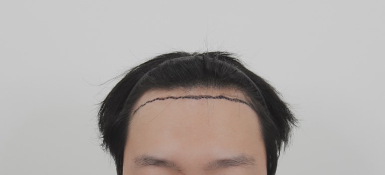 I've been to a doctor for 2,500 hair incision and hair transplantation. It's been a year
