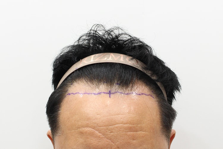 M자 때문에 고민하다가 결국 대전 리즈모에서 모발이식 했습니다^ ^