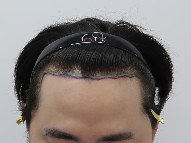 (11개월 후기)압구정 맘모스헤어라인의원 석지웅 원장님 / 비절개 355모낭 수술 후기