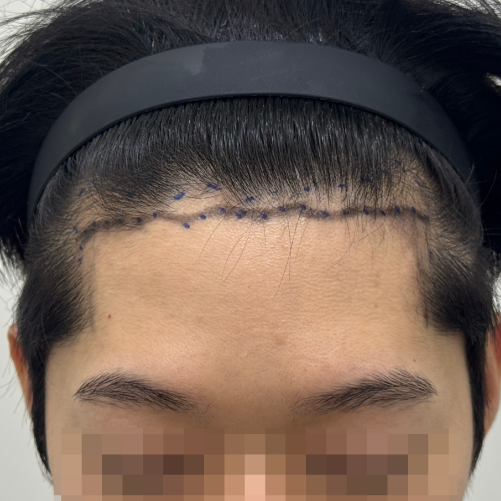 비절개모발이식 1000모만 심었슴다 (feat.용닥터의원 박원장님)