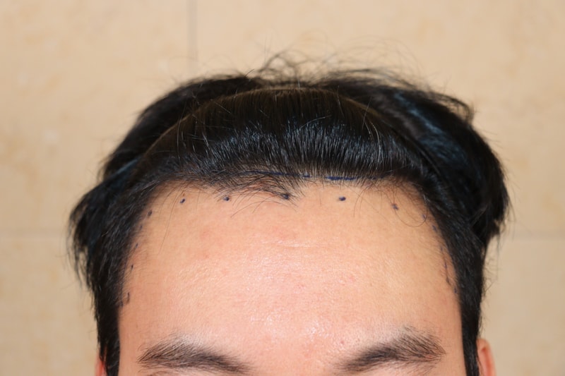 움찬의원 모발이식 M자 헤어라인 수술 2일차