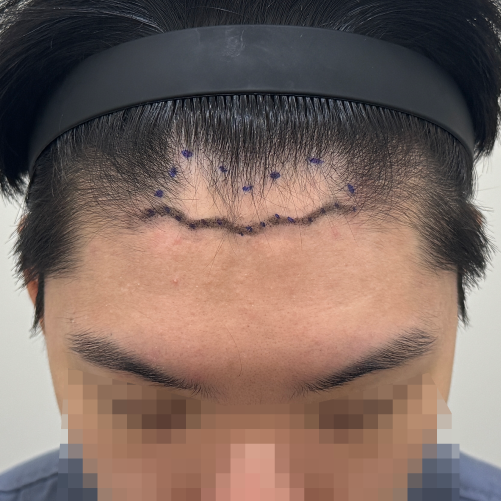 용닥터의원 2주차 1000모 남자 모발이식 경험담