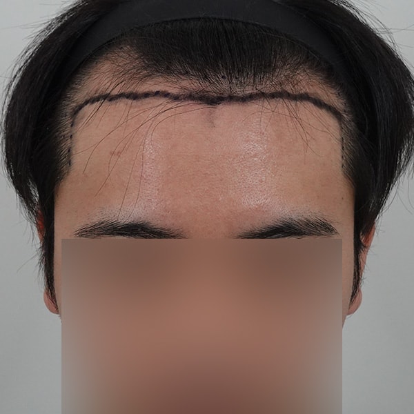 20대남 비절개 2100모 모발이식 1년차 후기입니다.