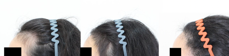 신사역 모프로의원,헤어라인교정3688모, 현직 피부과의사 6개월 경과