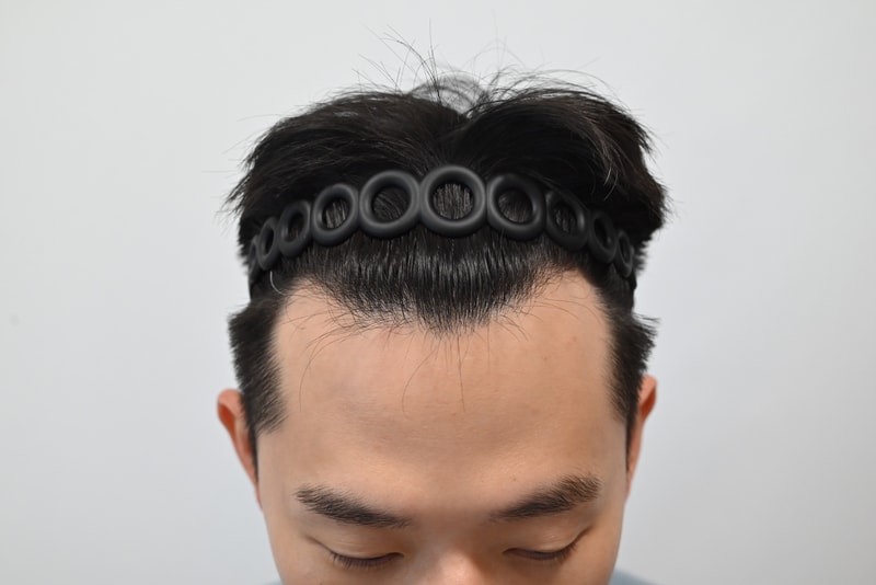 [모엠의원] M자 1200모 히든컷 비절개 후기!