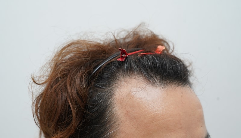 [연세모나의원]드디어 머리 심었습니다