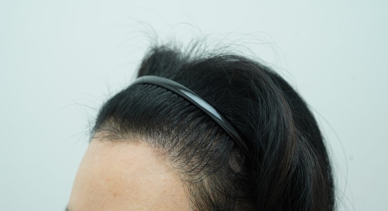 [연세모나의원]헤어라인 모발이식 4000모 남편 성공사례 따라 받은 후기