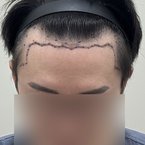 용닥터의원에서 헤어라인 모발이식했습니다^^