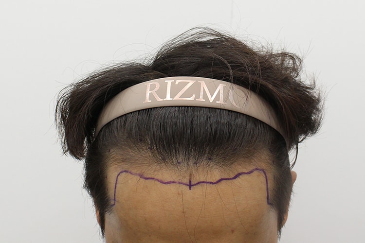 대전 리즈모의원 비절개 모발이식 3800모 2주차 후기입니다^^