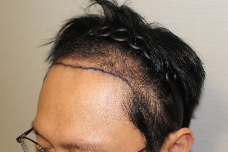 모다올 / 홍준현원장님 / 3700모@ / 비절개 / 1년경과 후기