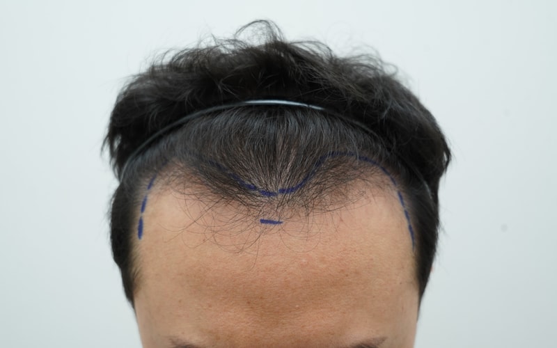 [연세모나의원]1510모낭(약3800모) m자 수술직후부터 암흑기 시작까지