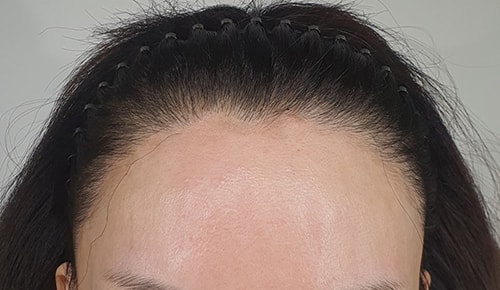 압구정 모우림의원 절개 모발이식 수술 후기 5일차에요^^