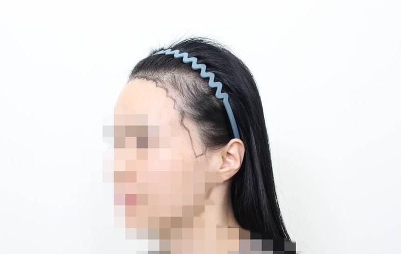 ★모프로의원★ 헤어라인,구레나룻,카우릭교정,4200모 이식 10일차