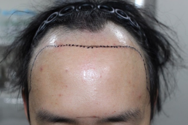 모다올 양유군 원장님 비절개 4800+@모 모발 이식 수술후 6일차 후기