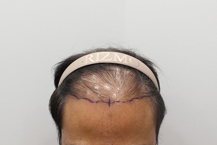 대전 리즈모 비절개 모발이식 3500모 심었습니다 원장님 금손입니다