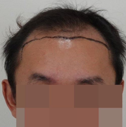 30대중반 용닥터 비절개 3300모 모발이식 받았습니다