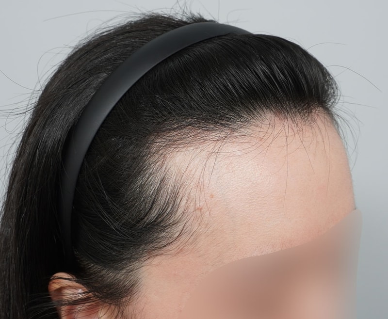 압구정 서진성형외과 여성헤어라인 이마축소 모발이식 1년 지난 후기