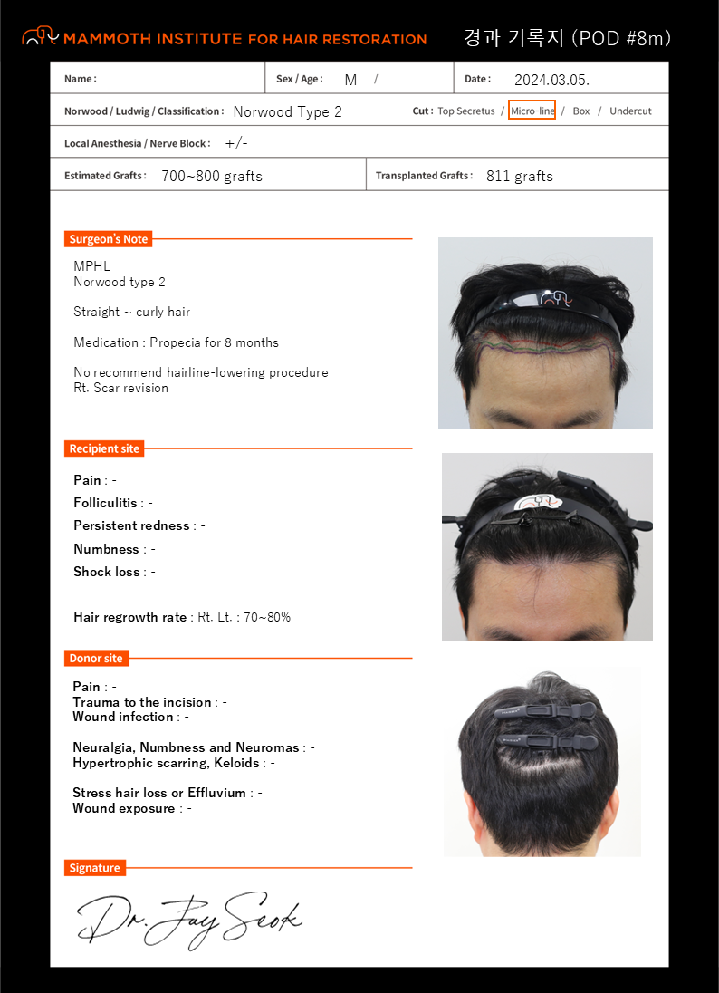 [압구정 맘모스 M자 비절개 모발이식 7개월 경과 후기]