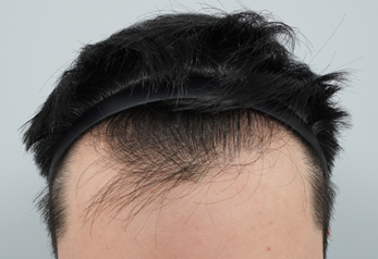 서진성형외과에서 유전성 M자 탈모+관자 3500모 모발이식 했습니다