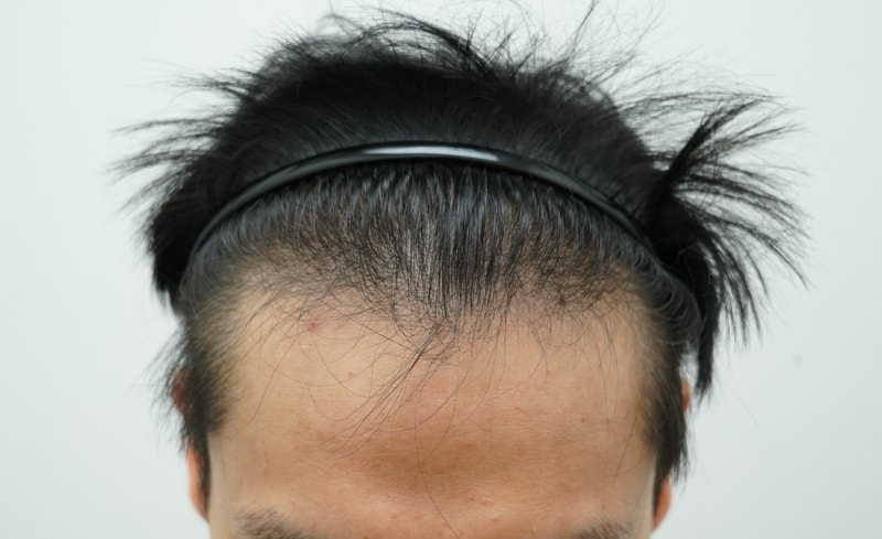[연세모나의원]M자 탈모 3주 후기