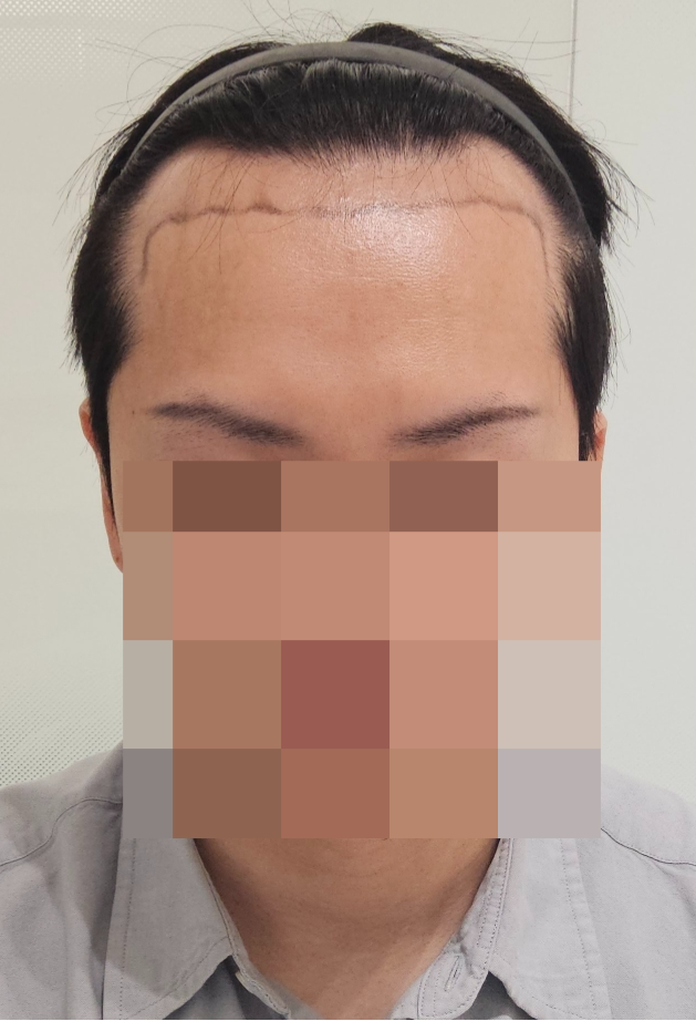 신논현 용닥터의원 4000모 모발이식 1년차