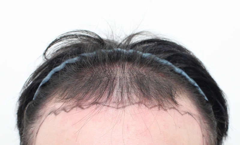 ★모프로의원★ 모발이식 5000모 23일 차 후기