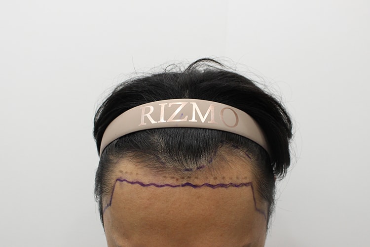 6군데 상담다녀보고 대전 리즈모로 최종 결정했습니다