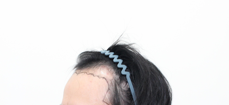 신사 모프로의원 / 모발이식 / 9일 경과