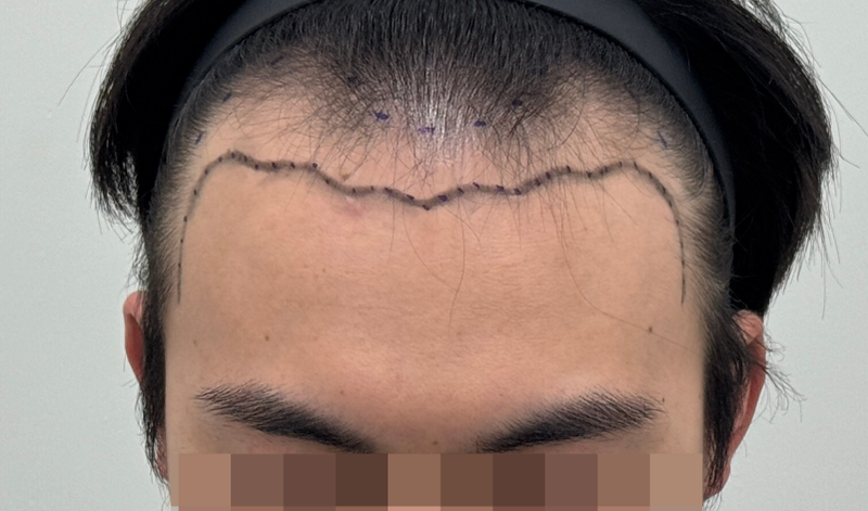 용닥터의원 m자 헤어라인 교정 4400모 이식받았습니다