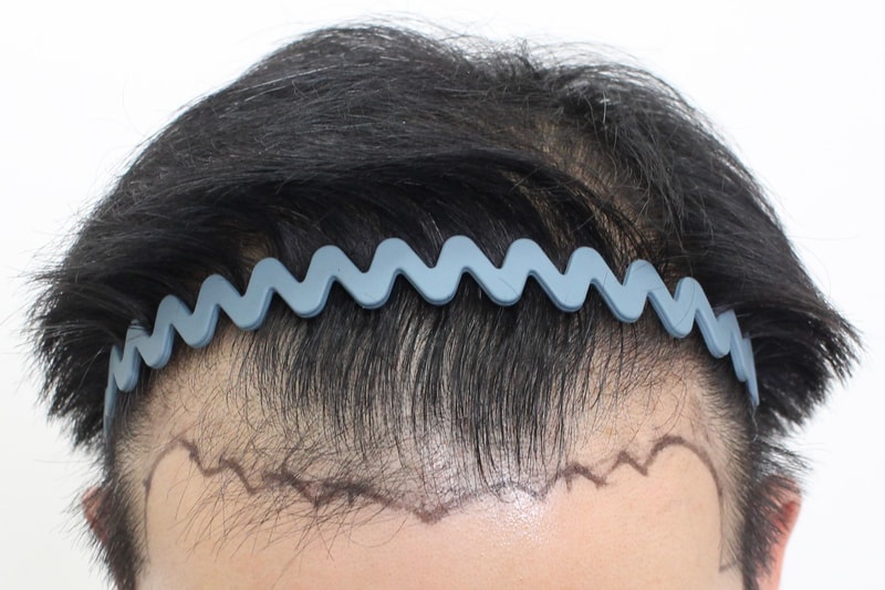 모발이식 3600모, 11일 차 후기