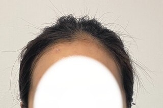 신사동 모프로의원, 헤어라인 이식, 10일차 후기