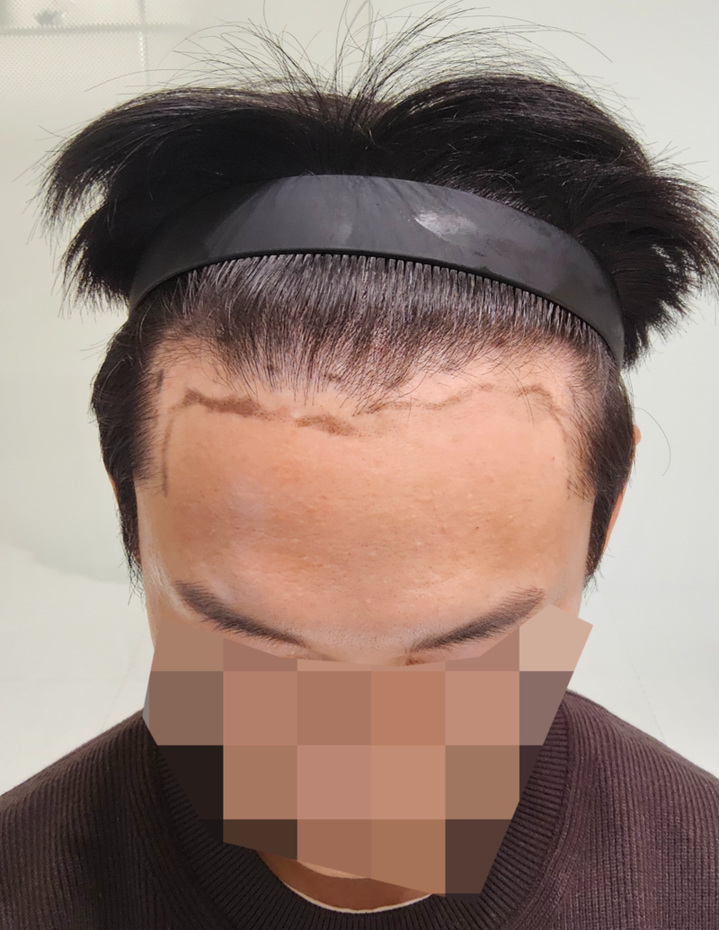 용닥터의원 모발이식 1600모 후기 남겨봅니다