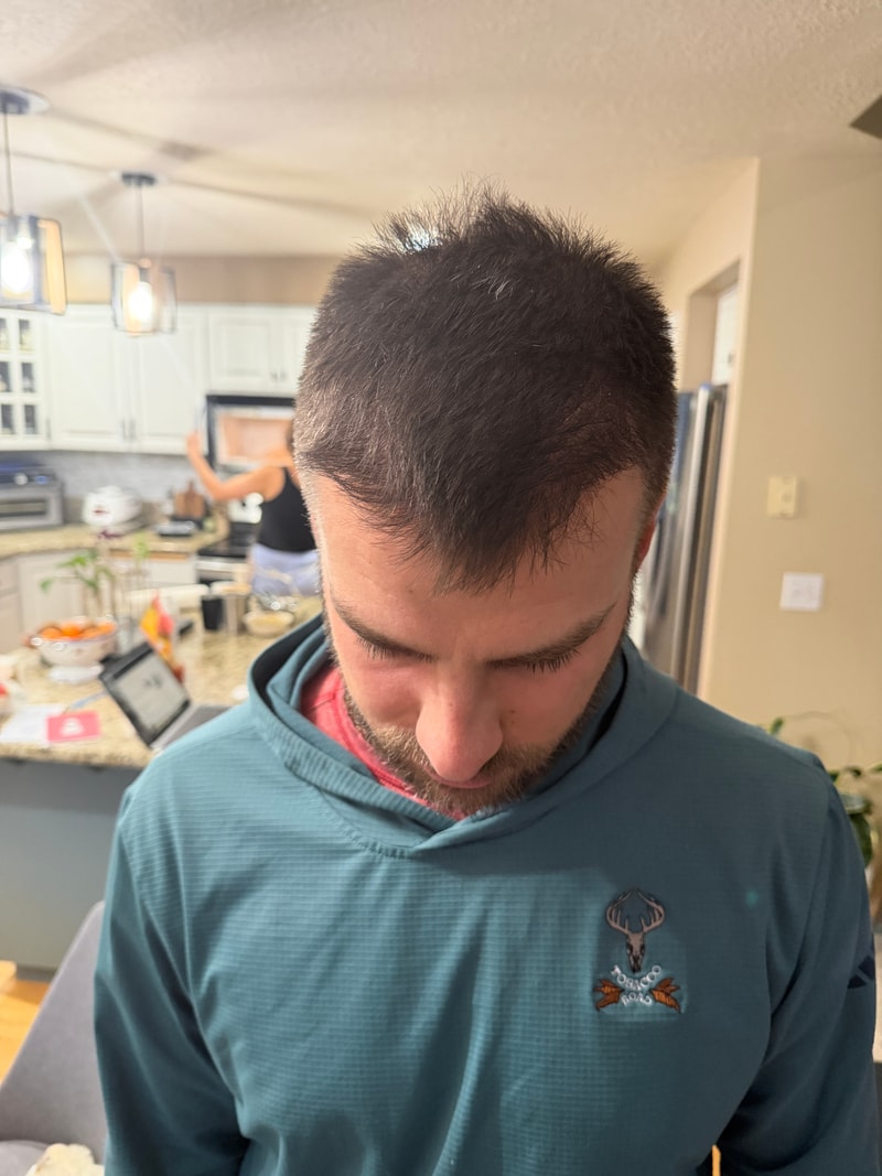 6개월 모엠 클리닉 모발 이식