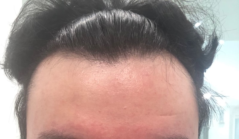 모디헤어플란트에서 3300모 받은지 벌써 1년이네요