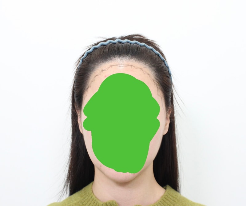 신사역 모프로의원, 재수술 헤어라인+구레나룻 이식, 17일 경과 후기