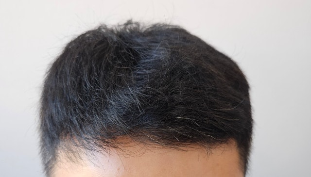 비절개 3800모 240일 후기 입니다.