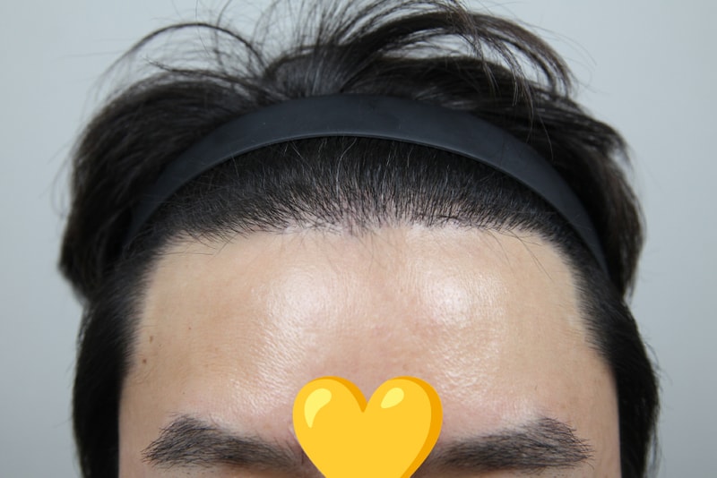 털이란 털은 다~ 이식하고 4달차 (헤어라인+눈썹+수염).