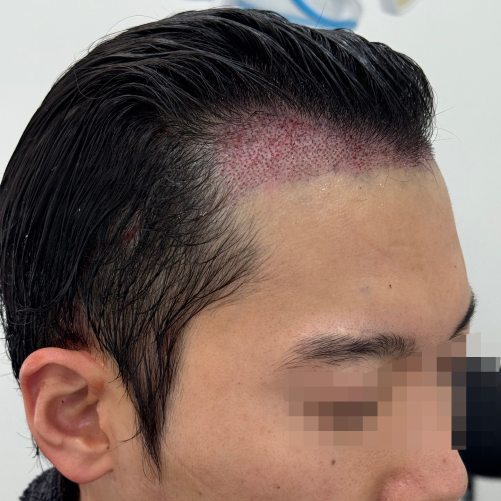 용닥터 (박상현의사) 비절개 2400모